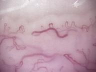 riduzione densità capillare fenomeno di Raynaud